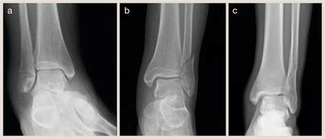 Ankle fractures and their management - Surgery - Oxford International ...
