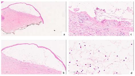 Concomitant Severe Psoriasis and Bullous Pemphigoid Induced by COVID-19