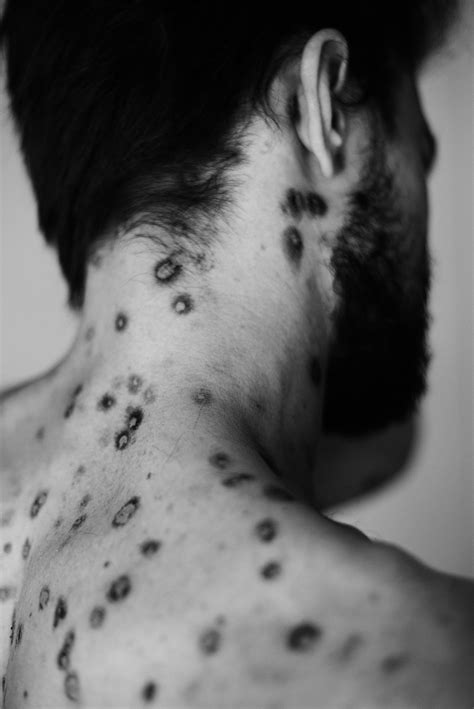 Mr Chickenpox — Teletype