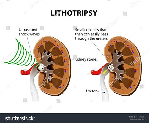 Extracorporeal Shock Wave Lithotripsy (Eswl) For Kidney Stones. Shock ...
