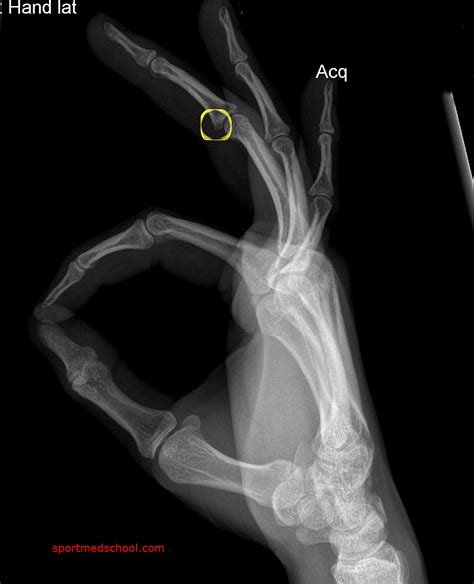 CASE 6 - IN A JAM | Sport Med School