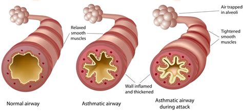 Bronchial Asthma | Asthma Attack Symptoms | Allergy Prevention