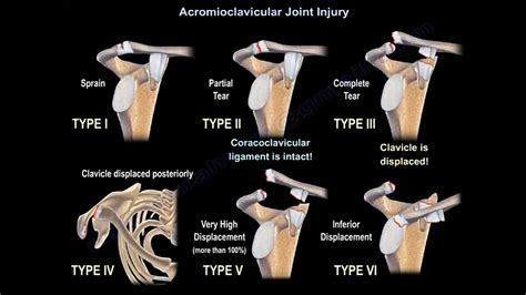 Acromioclavicular Joint Injury — OrthopaedicPrinciples.com