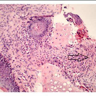 Image result for Caustic Tissue Sample