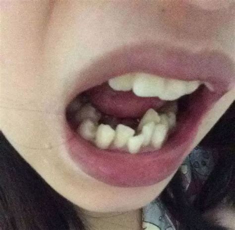 正常人有多少颗牙齿呀? - 知乎