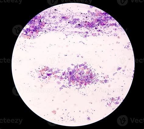 vista microscópica de la prueba de Papanicolaou que muestra un negativo grave para la malignidad ...