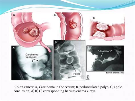 Imaging of Large Bowel Polyp | PPTX