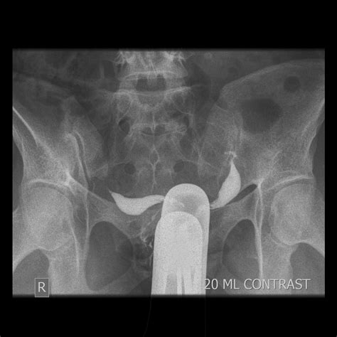 Uterus Didelphys [Get 30+] Uterus Didelphys Radiology