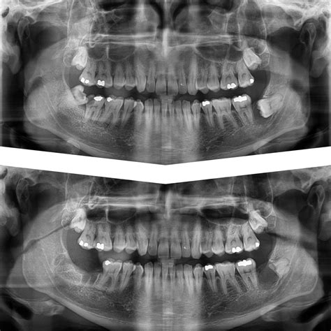Surgical Extraction 12 的图像结果