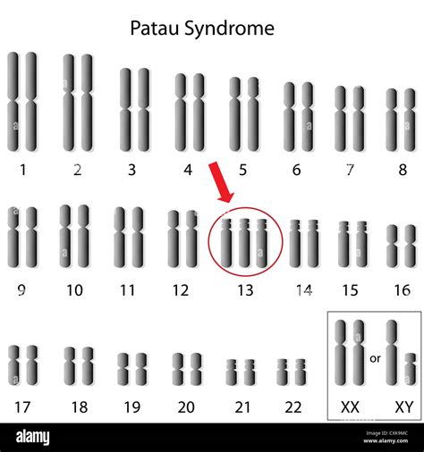 Patau syndrome, trisomy 13 Stock Photo - Alamy