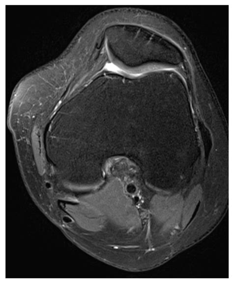 Medial Patellofemoral Ligament and Lateral Patellofemoral Ligament ...
