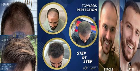 What Does Hair Transplant Growth Chart Look Like?
