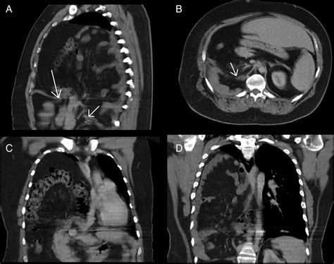 Massive symptomatic right-sided Bochdalek hernia in an adult man | BMJ ...