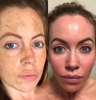 Obagi Nu-Derm Before & After Pictures - RealSelf