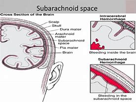 Image result for Subarachnoid