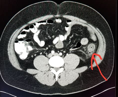 Ct Scan For Diverticulitis at Carlos Pratt blog