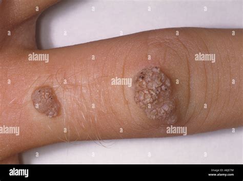 Common wart caused by HPV, Human Papilloma Virus Stock Photo - Alamy