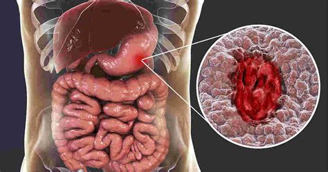Stomach Ulcers: Causes, Types, Symptoms, & Treatment