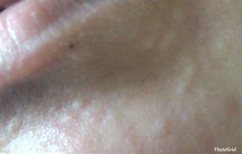 skin colored bumps on chin treatment - Page 2 - Hypertrophic (raised ...