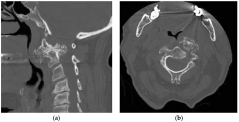 A Three-Step Submandibular Retropharyngeal Approach to the ...