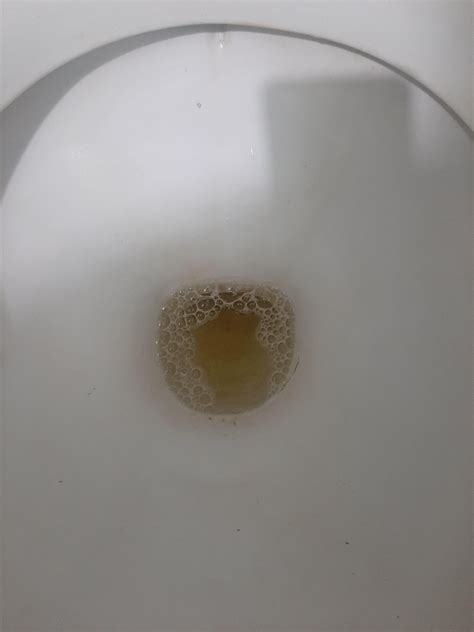 Is this bubbly or foamy urine? I have this type of urine almost every morning and it's extremely ...