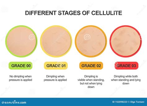 Diversas Etapas De Celulitis Escala De Clasificación Tratamientos Ilustración del Vector ...