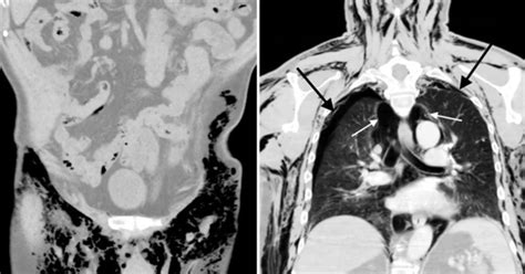 Man Left With 'Whistling' Scrotum After Bad Surgery