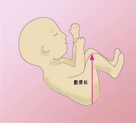 产检胎儿“股骨短”说明宝宝是小矮子？父母别慌，真正含义要了解