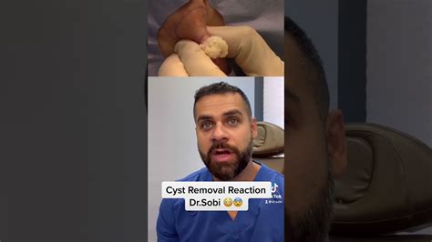 Image result for Cyst Extraction Videos