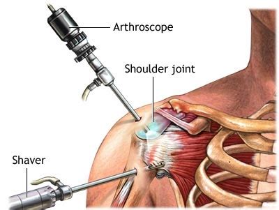 Image result for Rotator Cuff Repair Photo