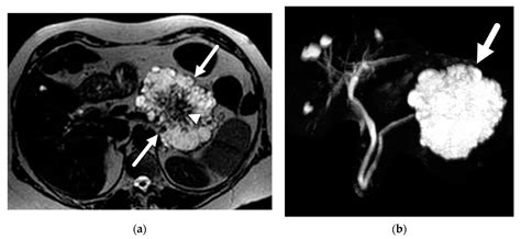 The Role of Magnetic Resonance Imaging (MRI) in the Diagnosis of Pancreatic Cystic Lesions (PCLs)