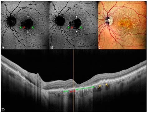 Blue Light and Green Light Fundus Autofluorescence, Complementary to Optical Coherence ...