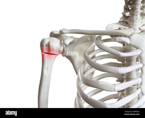 3d rendered medically accurate illustration of a broken humerus Stock ...