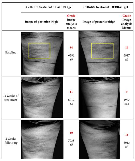 Efficacy of an Anti-Cellulite Herbal Emgel: A Randomized Clinical Trial