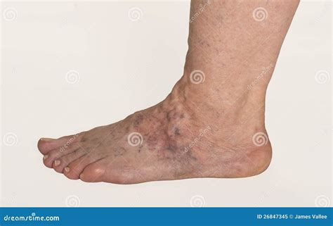 Varicose Veins stock image. Image of veins, artery, foot - 26847345