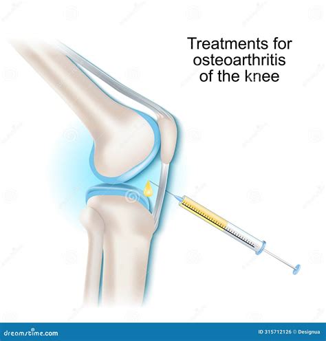 Treatments For Osteoarthritis Of The Knee Joint Vector Illustration | CartoonDealer.com #315712126