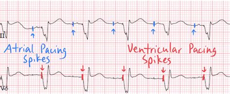 Dual AV Pacing Patterns: Understanding Atrial–Ventricular Pacing