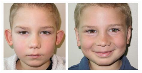 Otoplasty Salt Lake City UT - Ear Pinning Surgery Utah