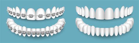 Braces & Aligners for Perfect Smiles in Delhi