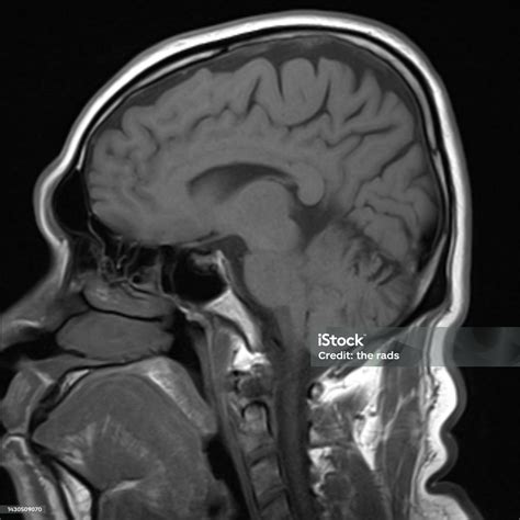 Normal Brain Mri Images Stock Photo - Download Image Now - Anatomy, Black And White, Brain Stem ...
