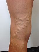 Varicose Vein 的图像结果