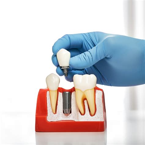 Are Dental Implants Safe? | Village Walk Family Dental
