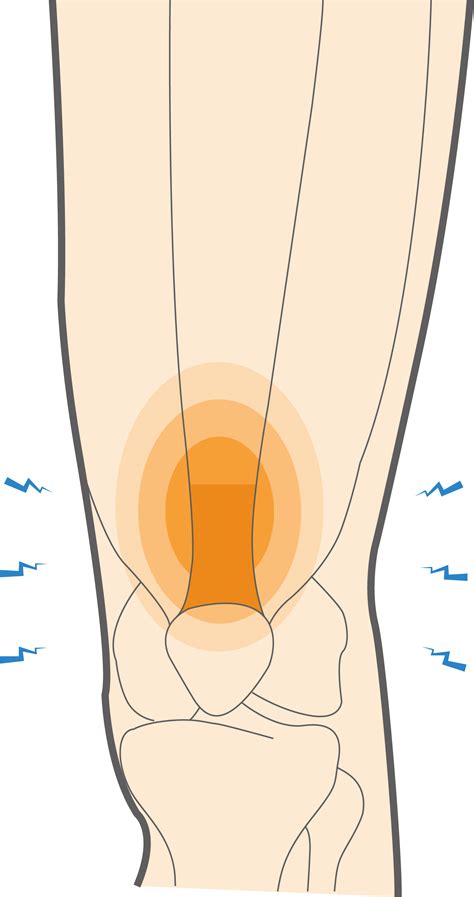 Quadriceps Tendonitis Hip Pain at Mia Fortune blog
