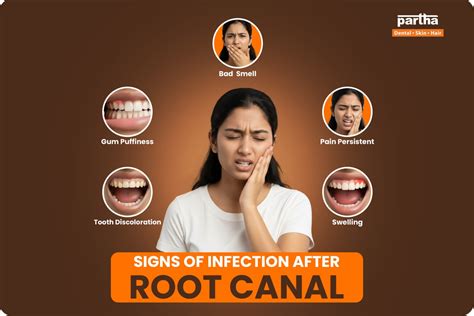 4 Signs Of Infection After Root Canal – Causes & Treatment