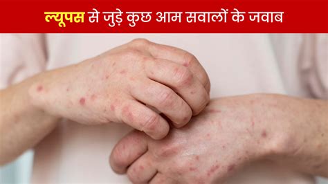 ल्यूपस से जुड़े आम सवालों के जवाब जानें एक्सपर्ट से | expert answers ...
