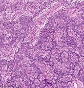 Image result for 肉瘤 Endometrial stromal sarcoma