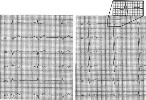 Posterior Myocardial Infarction Ecg
