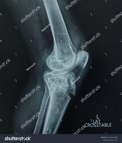 Tibial Tubercle Fracture