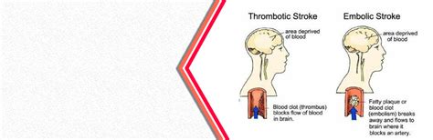 Difference between an embolic stroke and a thrombotic stroke?