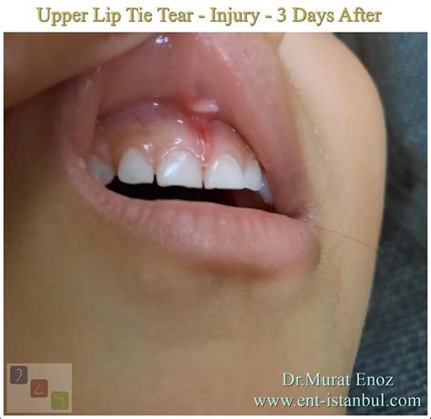 Upper Lip Tie Tear - Injury